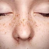 Facial Freckles-2